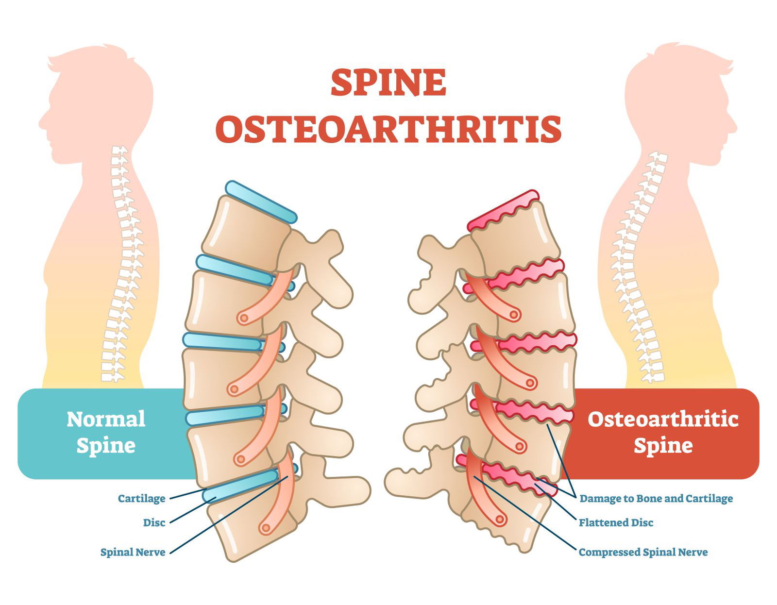 Osteoartritis Hrbtenice