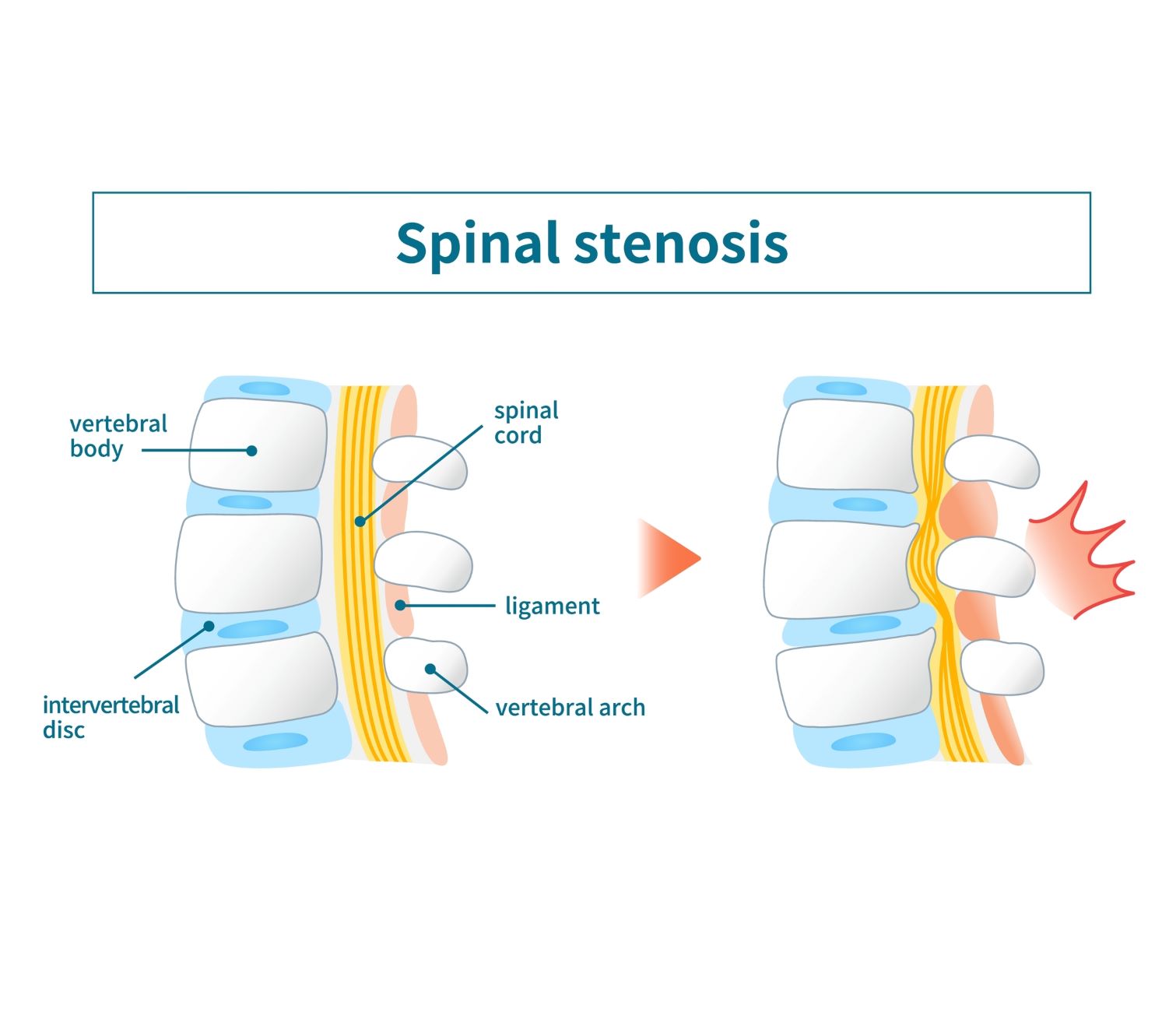 Spinalna Stenoza
