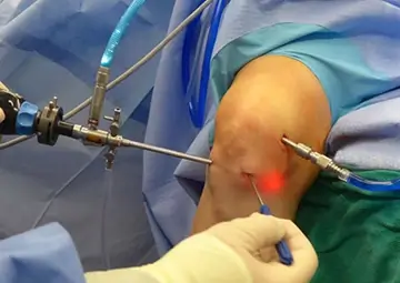 Operativni poseg na kolenu