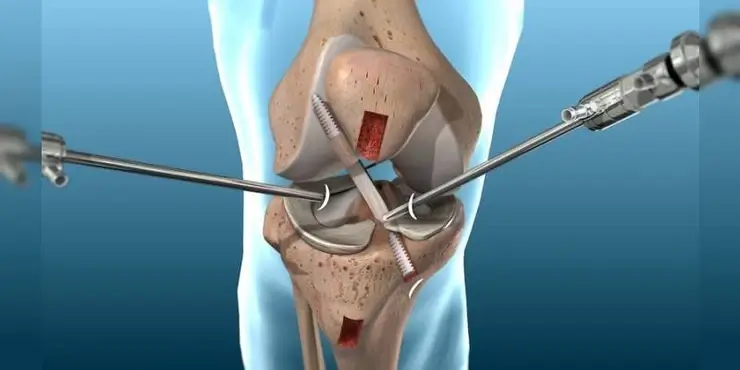 sklica operativnega posega na kolenu
