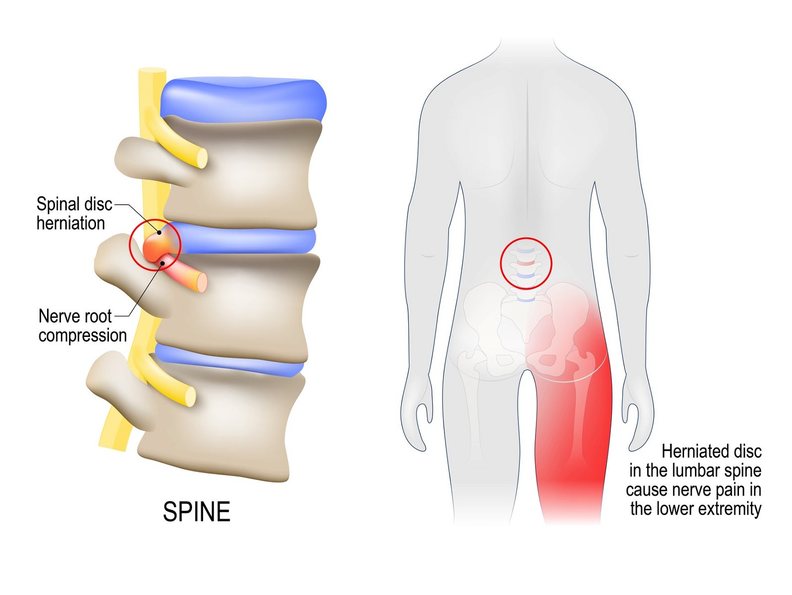 Hernija diska povzroča bolečino v hrbtenici išias