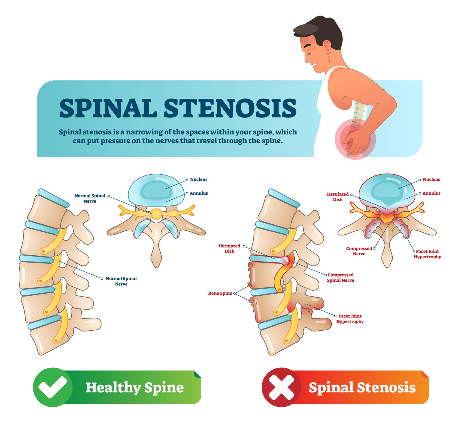 spinalna stenoza hrbtenice