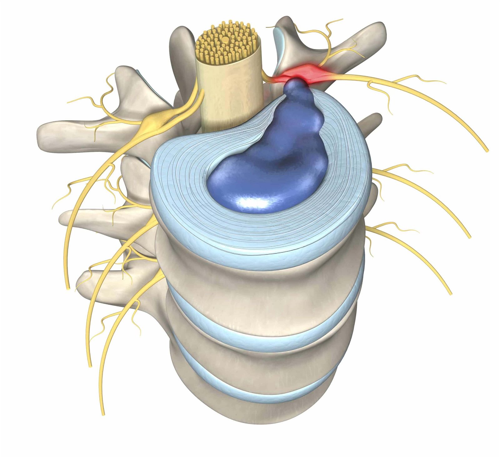Pridobljeni vzoki spinalne stenoze