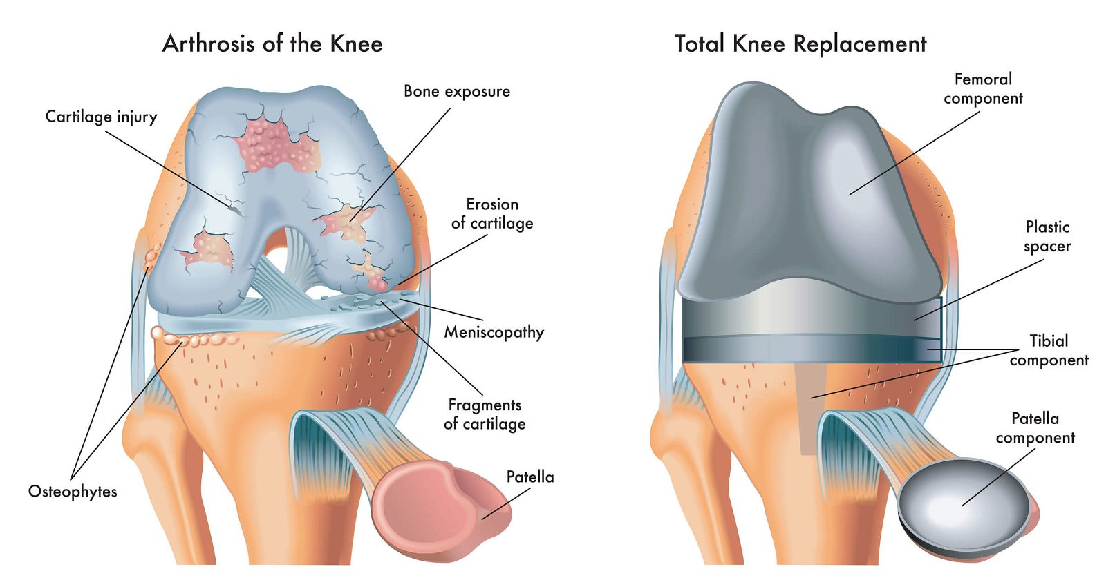 artroza totalna endoproteza kolena