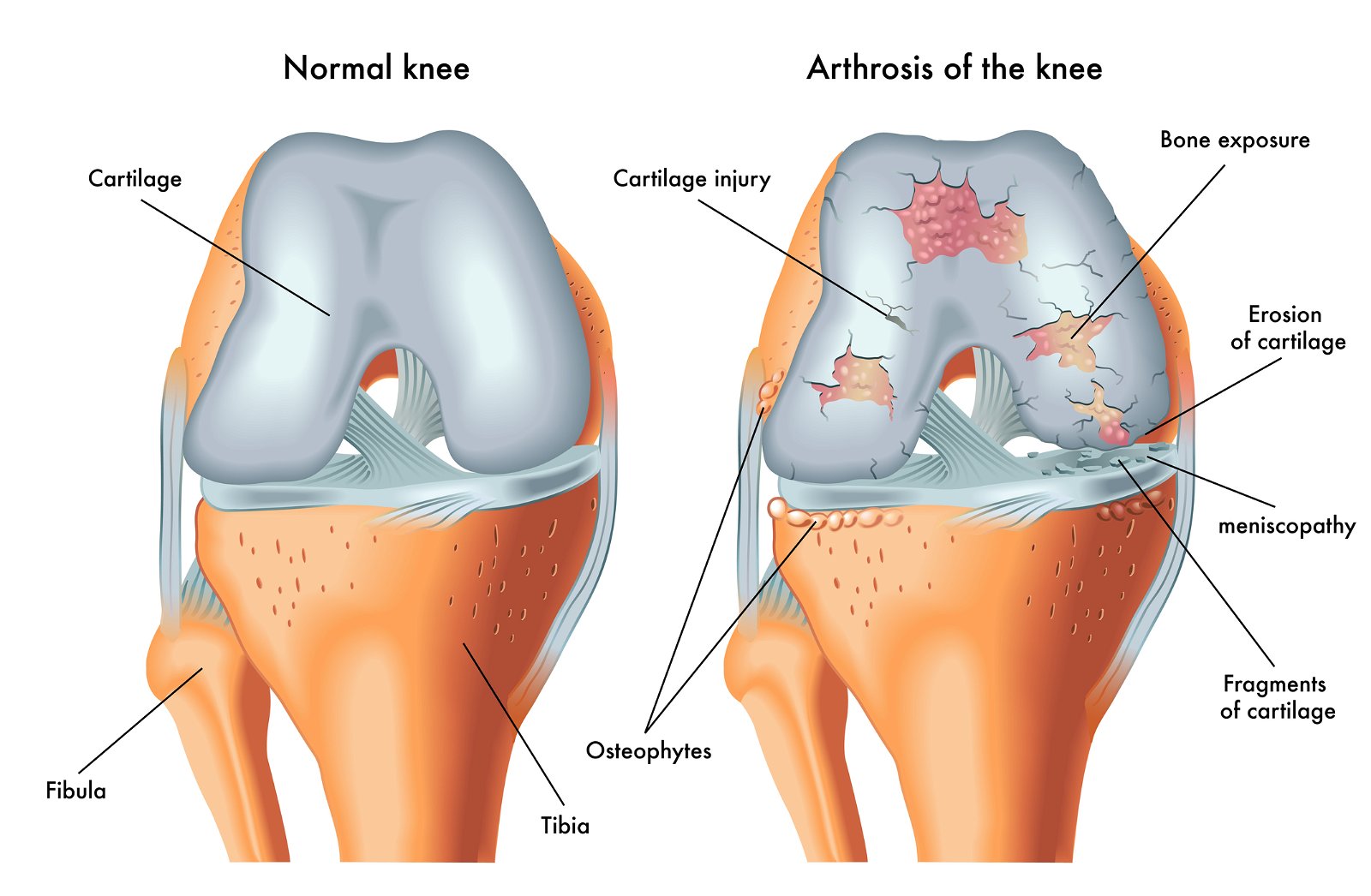 anatomija kolena in artroza