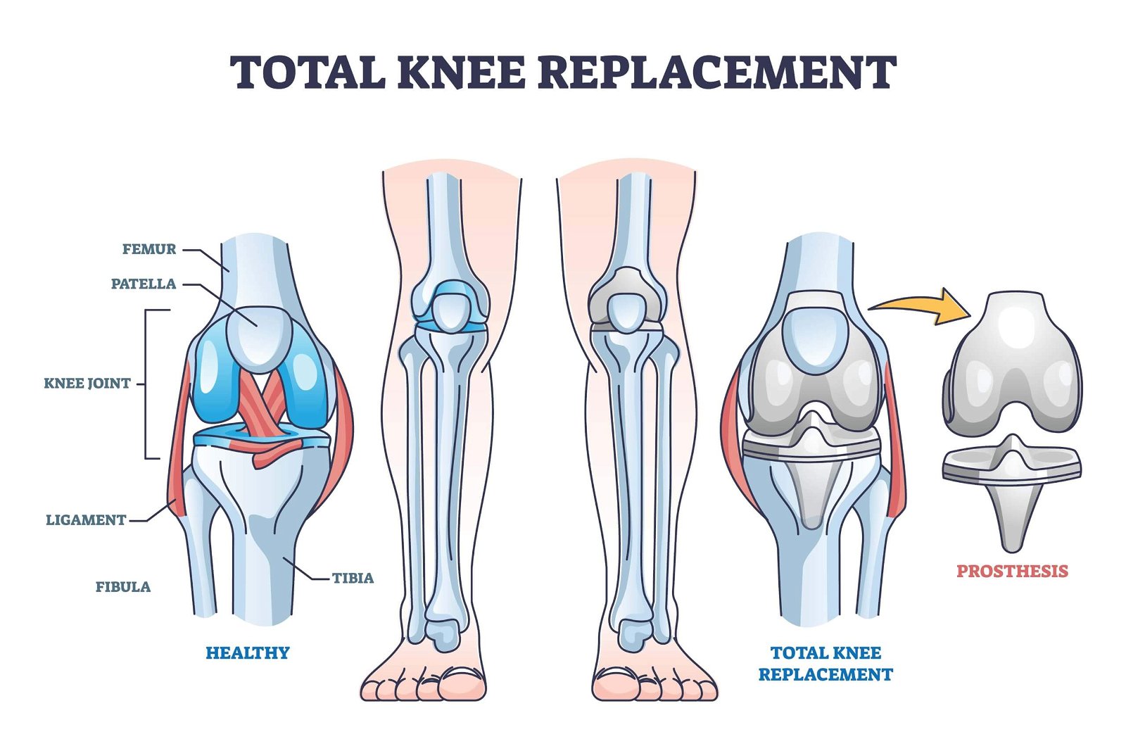 the process of total knee replacement procedure