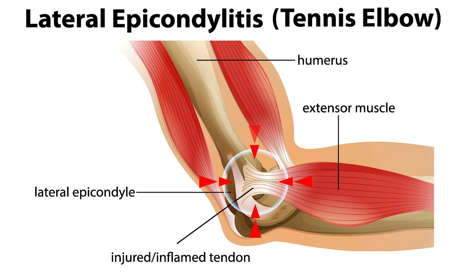 tennis-elbow-anatomy