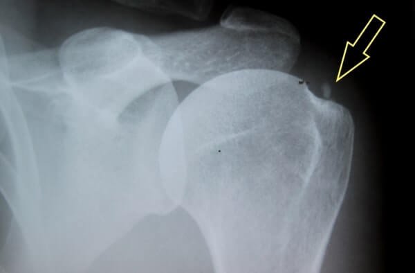 shoulder calcination under x ray
