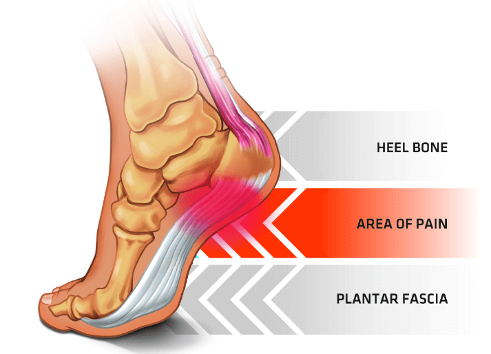 area of pain for heel spur