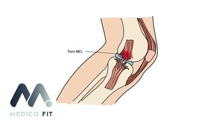 Knee ligament injuries sketch medicofit