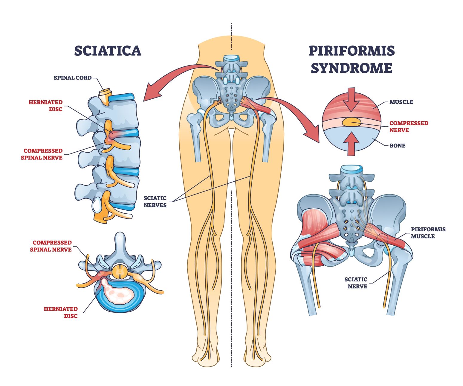 Razlika Med Išiasom In Piriformis Sindromom