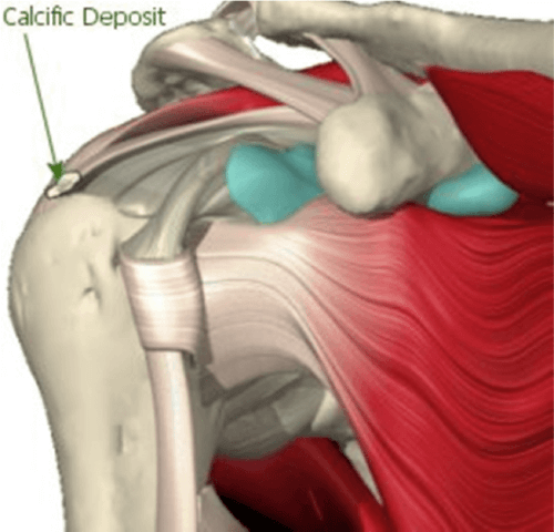 picture of calcific deposit in the shoulder area