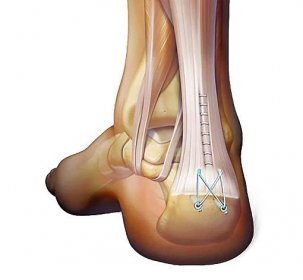 Achilles tendon diagnostics and illustration
