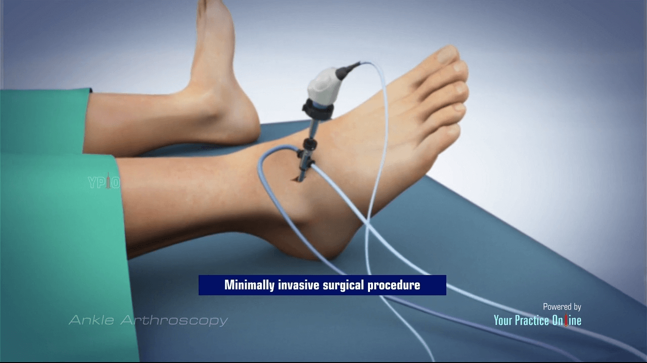 Arthroscopy of the ankle procedure