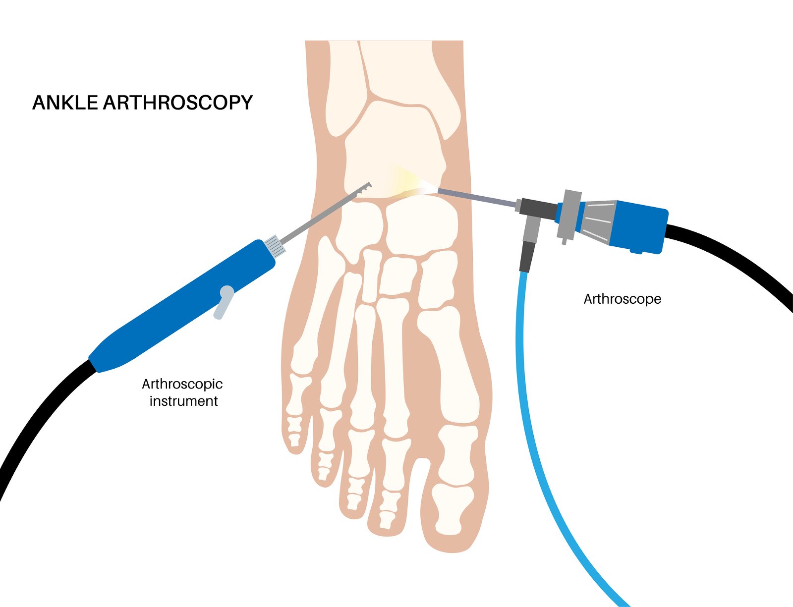 kirurški poseg artrospija gležnja