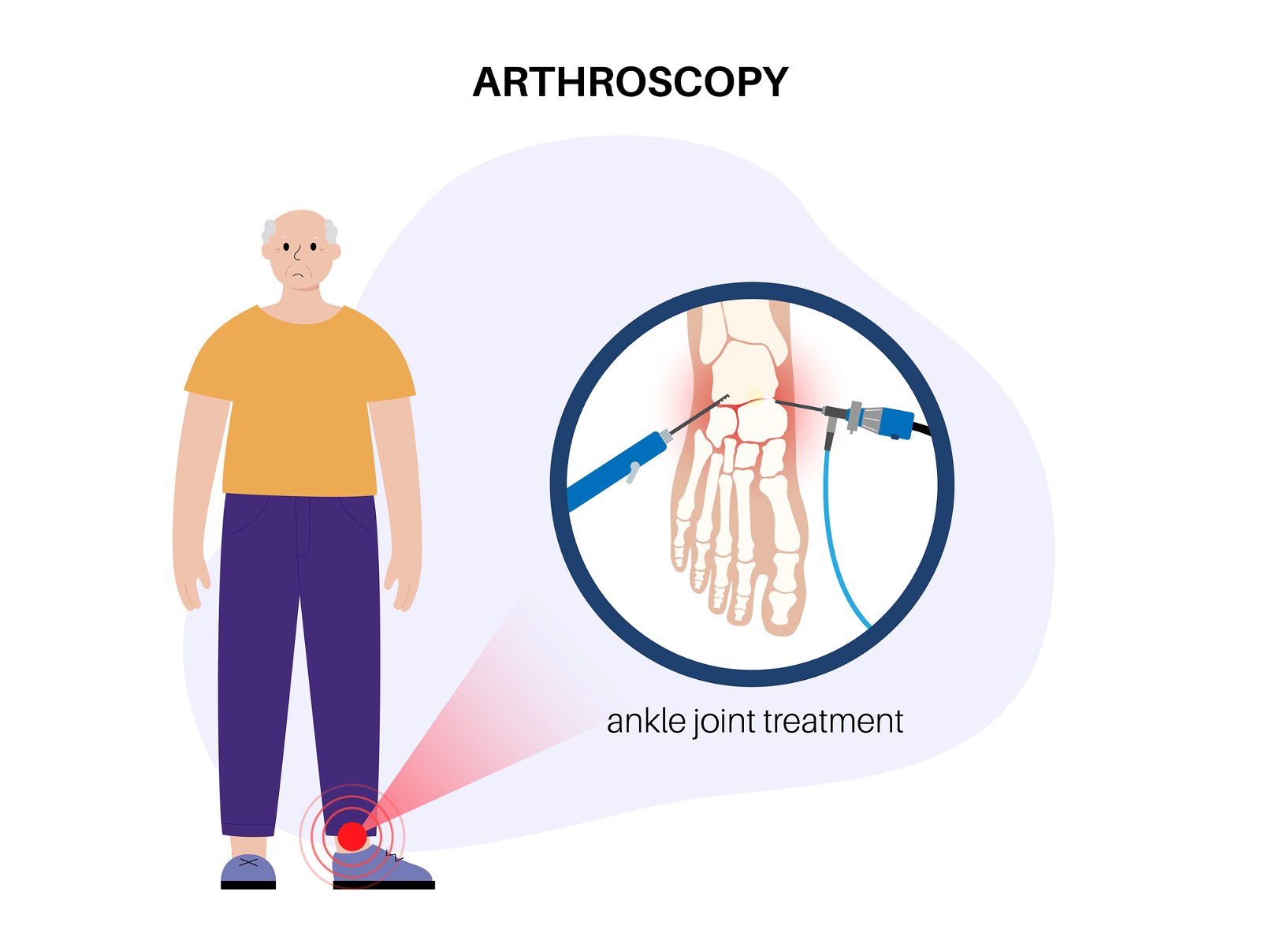 posteriorna artroskopija gležnja postopek
