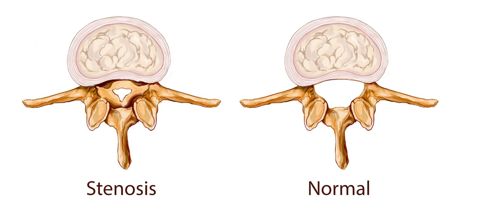 cervikalna spinalna stenoza