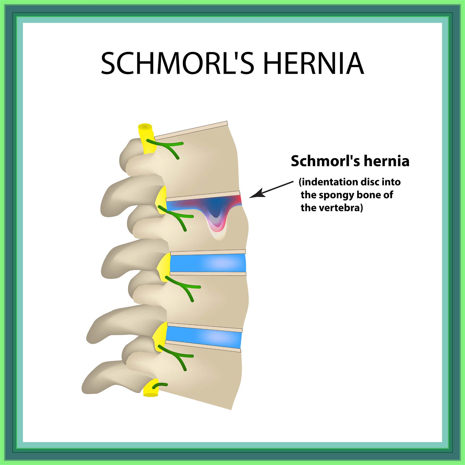 Hernia,Schmorl.,Intervertebral,Disc.,Side,View.,Spine.,Infographics.,Illustration,On