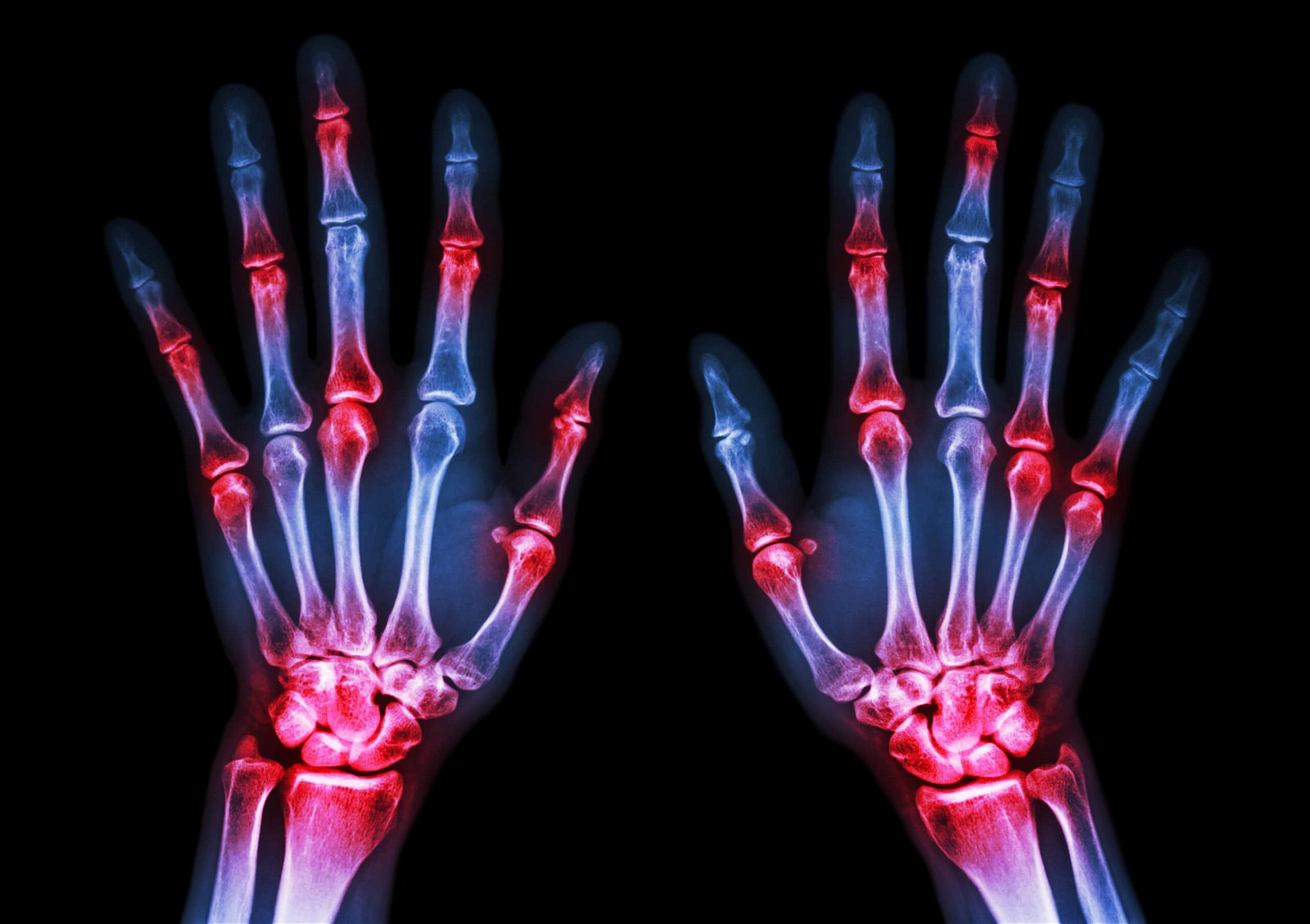 rentgen slika artritis zapestja osteoartritis