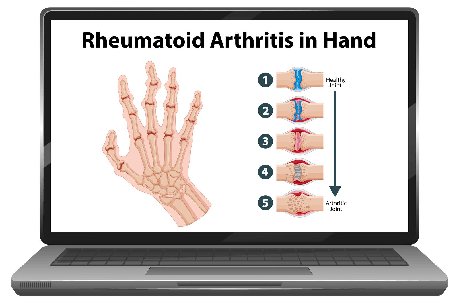 Revmatoidni artritis zapestja medicofit