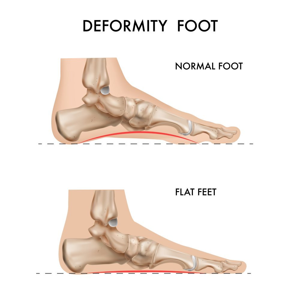 Anatomoja deformacije kosti zaradi ploskega stopala