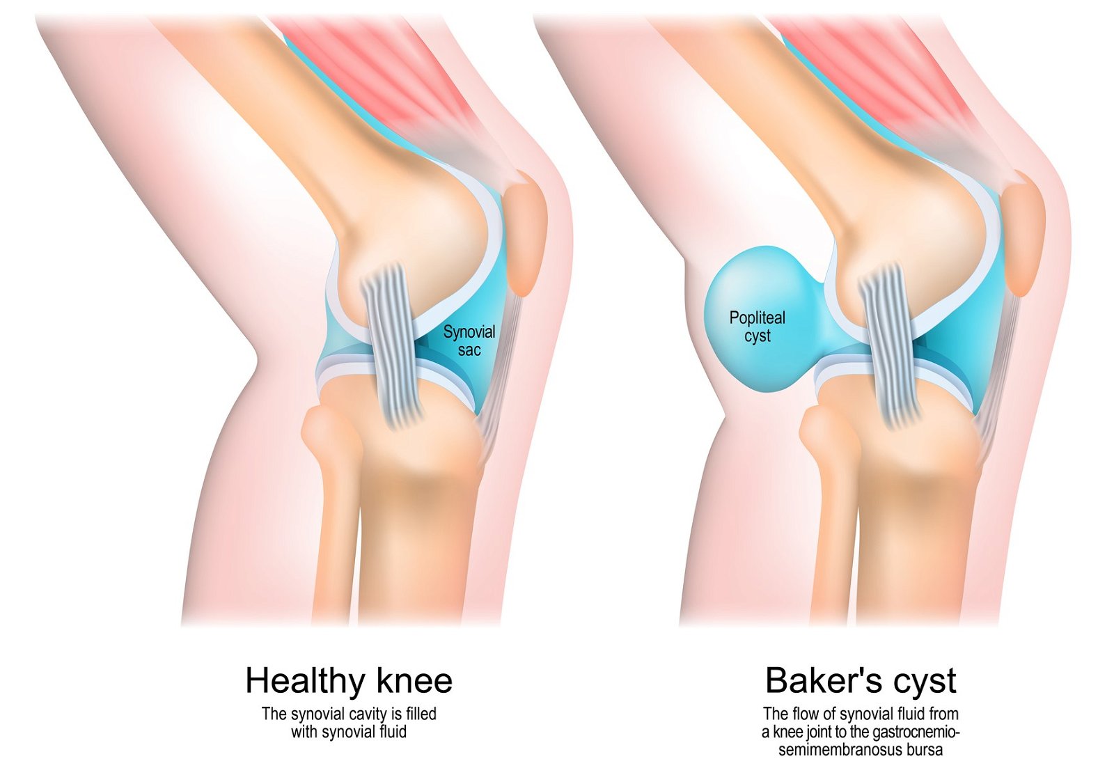 bolečina na zadnji strani kolena Bakerjeva cista
