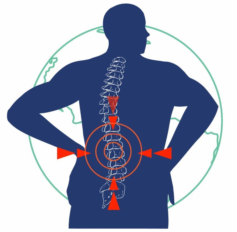 lokacija bolečine v hrbtu