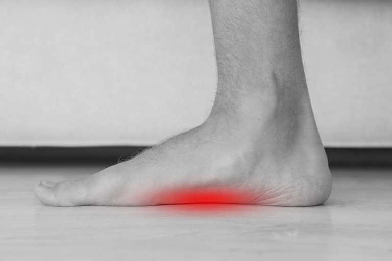 prikaz bolečine v stopalnem loku