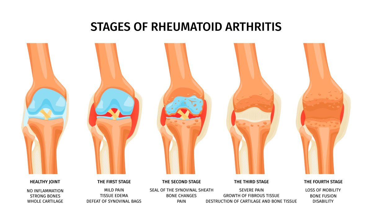 napredovanje revmatoidnega artritisa