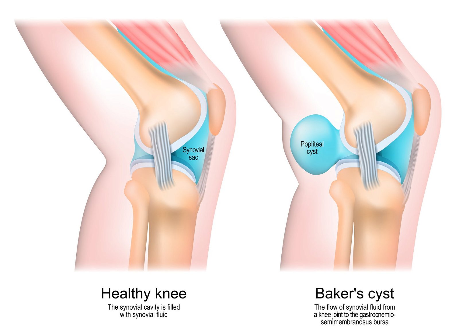 Bakerjeva cista in zdravo koleno