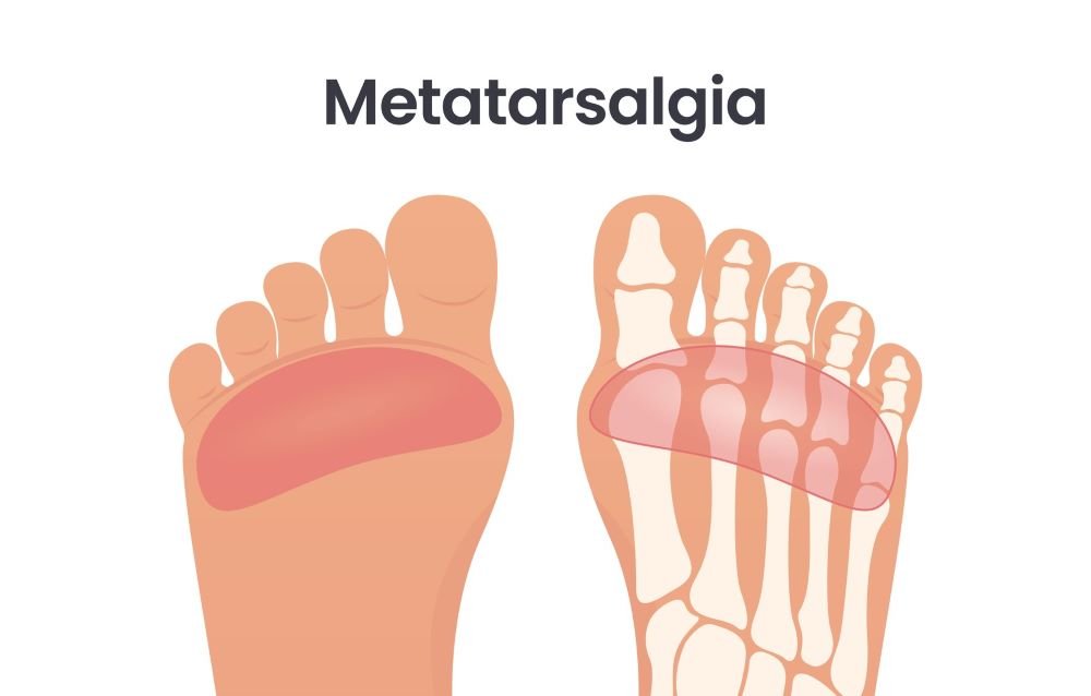 Metatarzalgija povzroča bolečine v stopalu spredaj