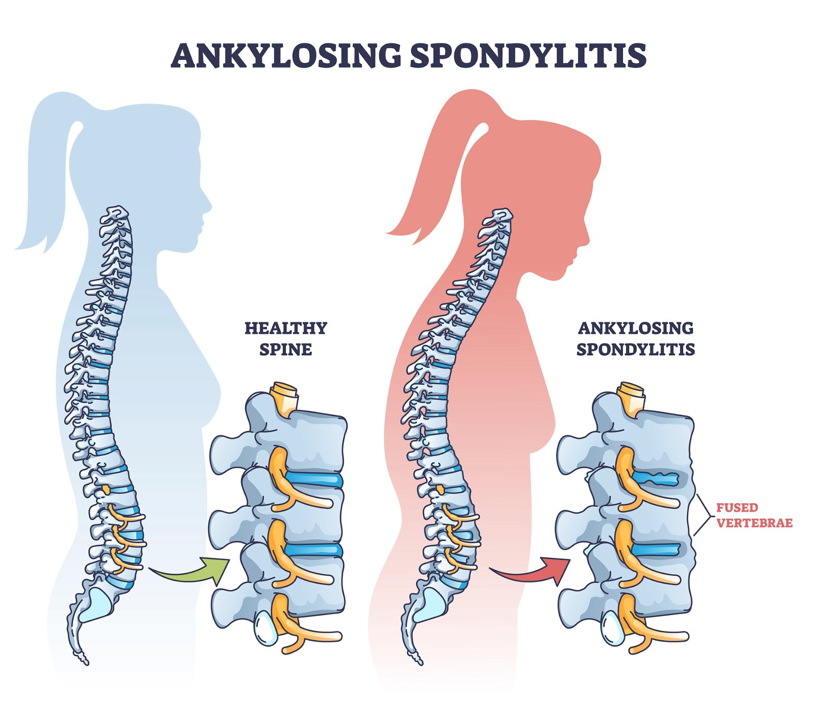 simptomi ankilozirajoči spondilitis