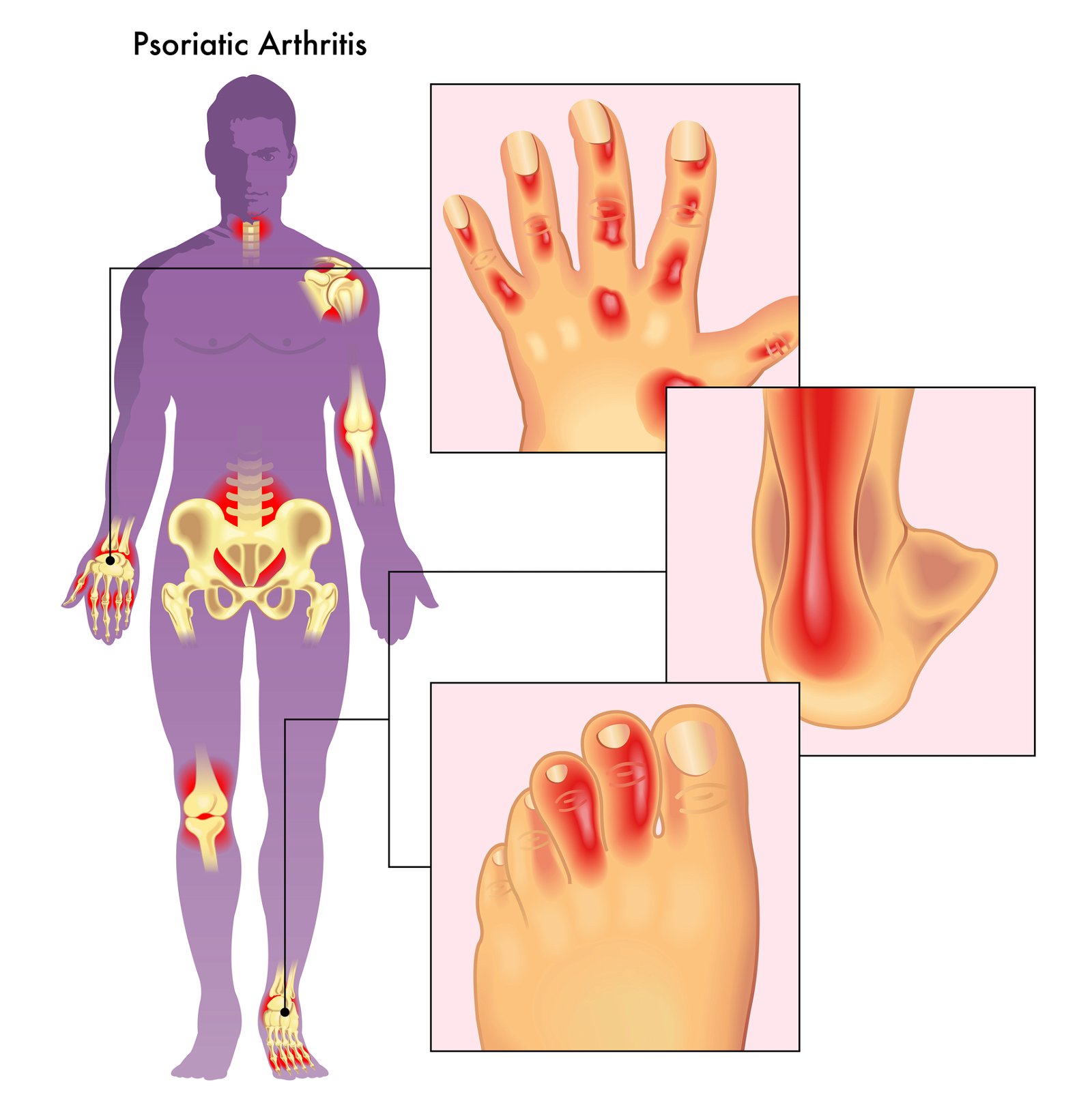 Simptomi psoriatični artritis