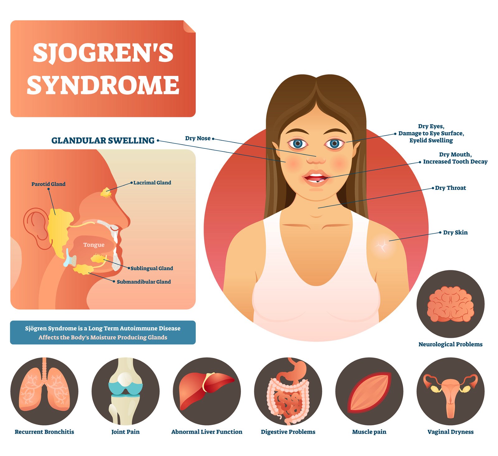 Simptomi Sjögrenov sindrom