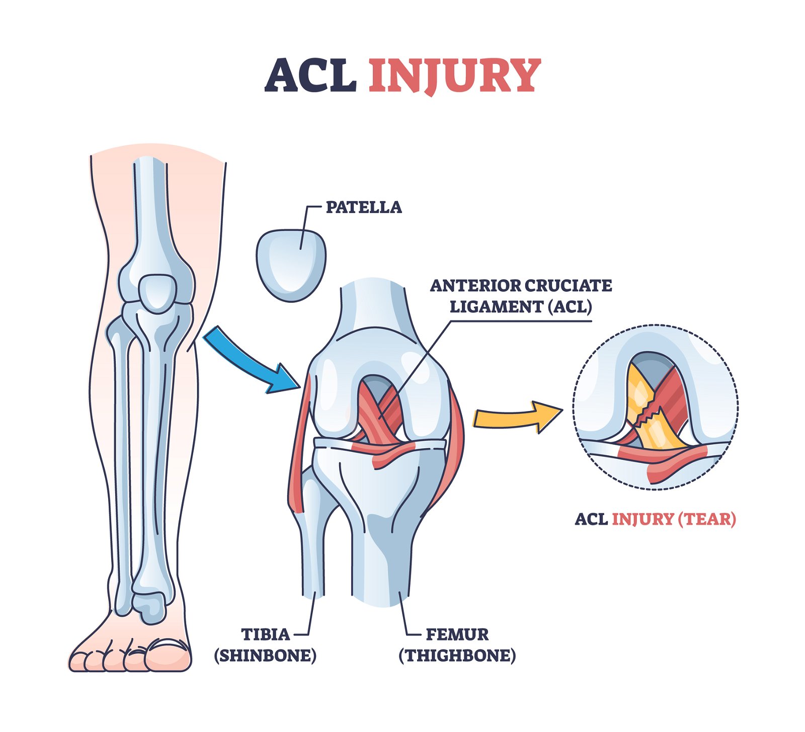 Poškodba sprednje križne vezi ACL