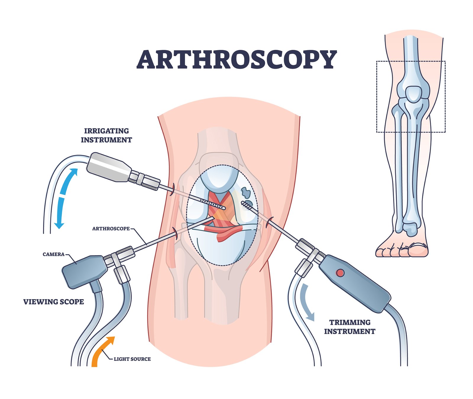 Operacija ACL postopek artroskopije