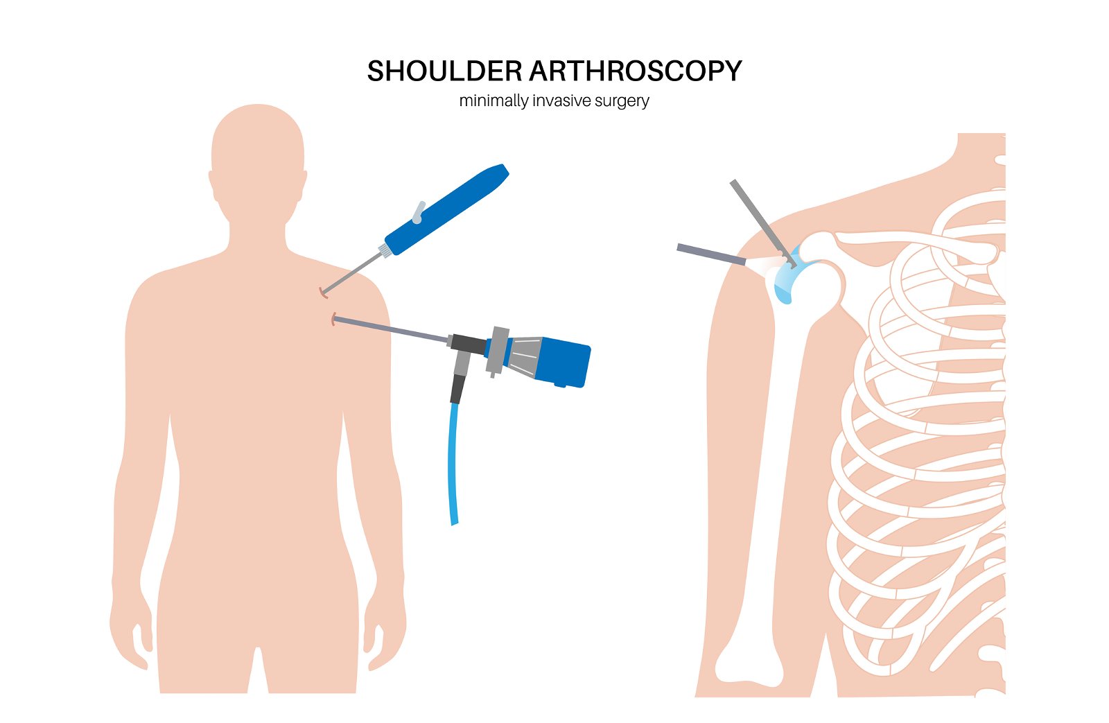 postopek artroskopija ramena