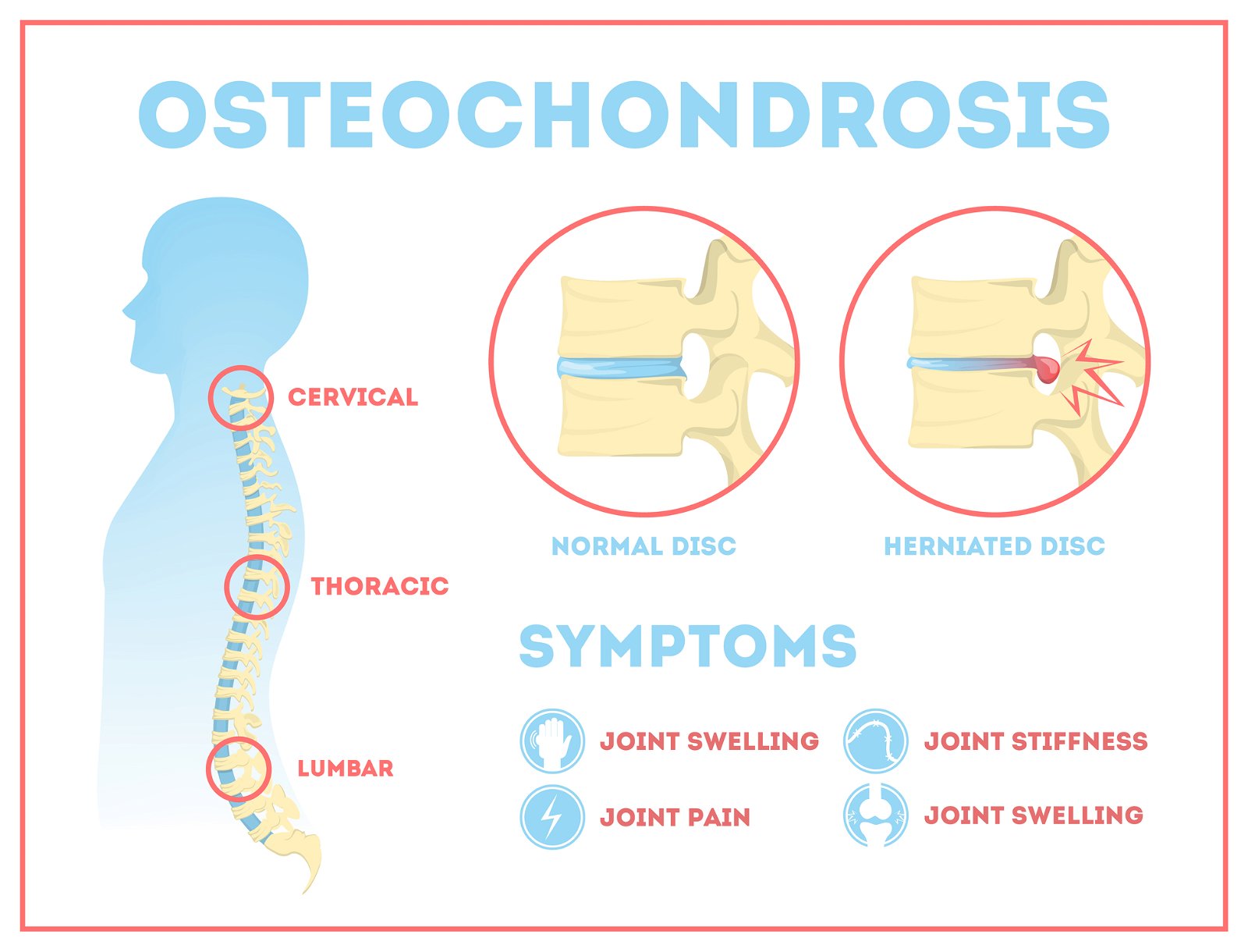 osteohondroza simptomi bolečine v križu