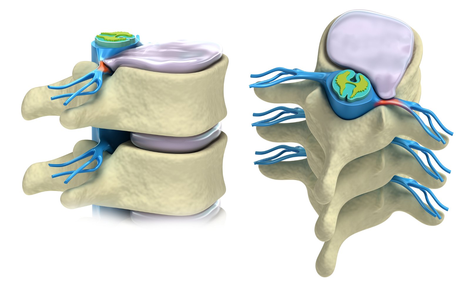 osteohondroza in hernija diska
