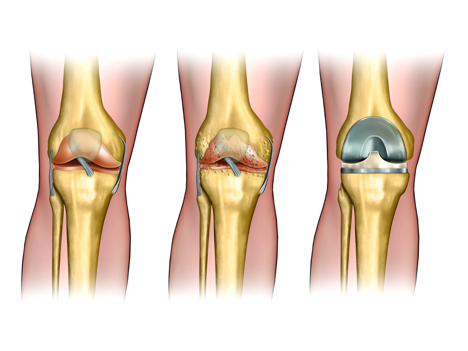 artroza kolena operacija