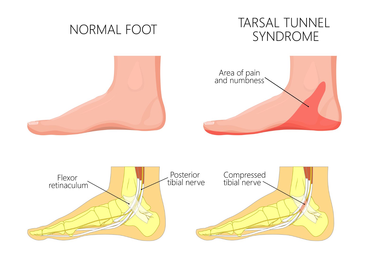 sindrom tarzalnega kanala bolečina v peti