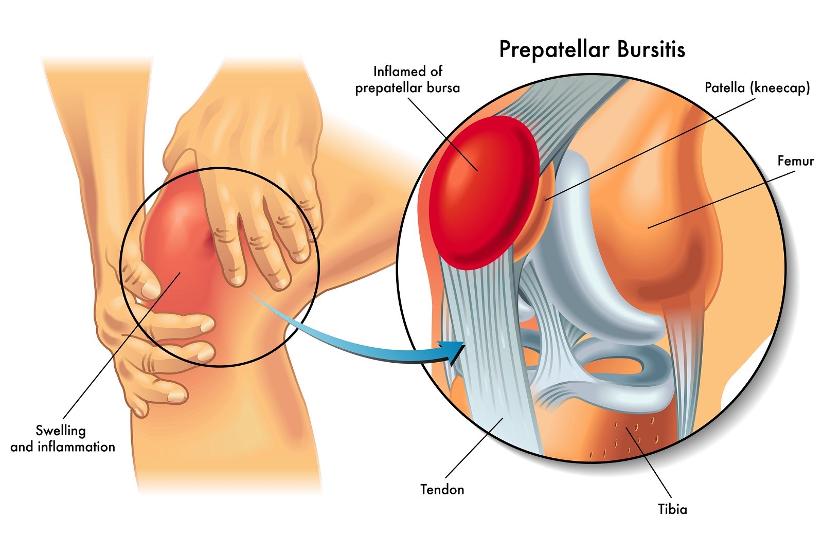 Prepatelarni burzitis kolena