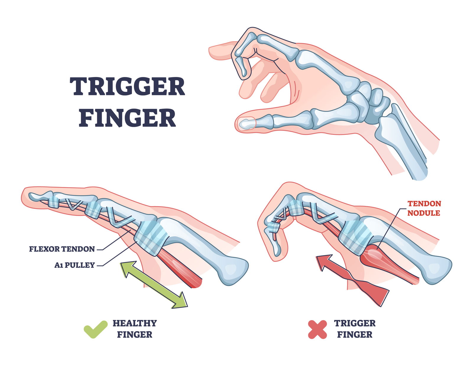 Trigger Finger sprožilni prst vnetje tetive