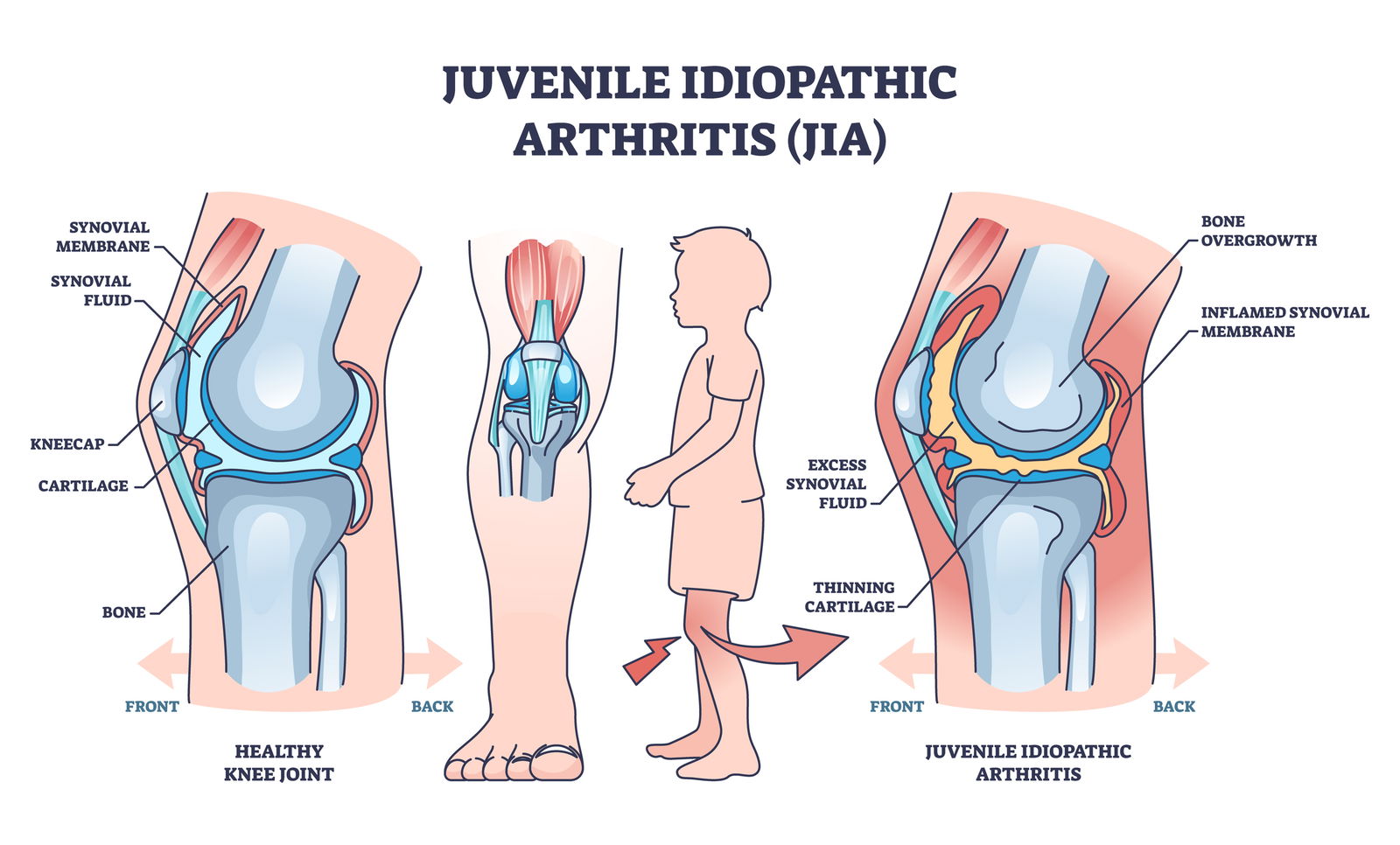 juvenilni idiopatski artritis mladi