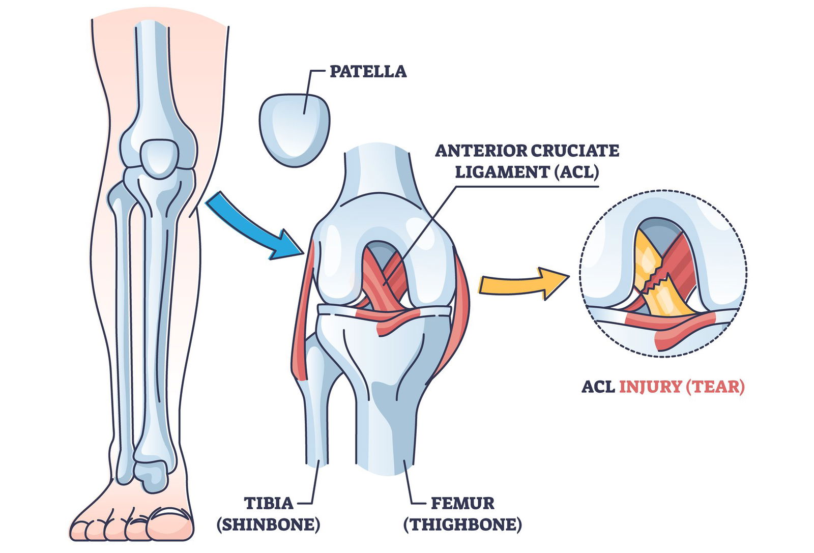 parcialna totalna ruptura ACL simptomi