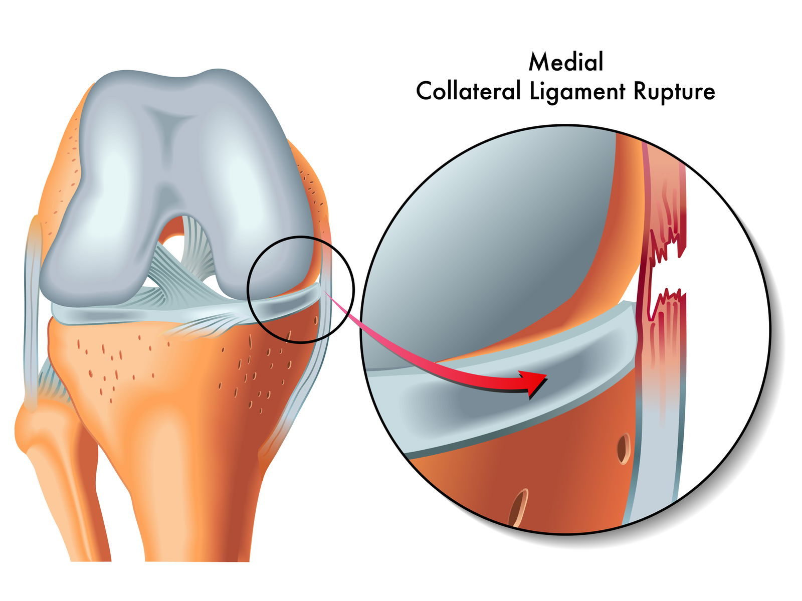 Ruptura MCL medialnega kolateralnega ligamenta