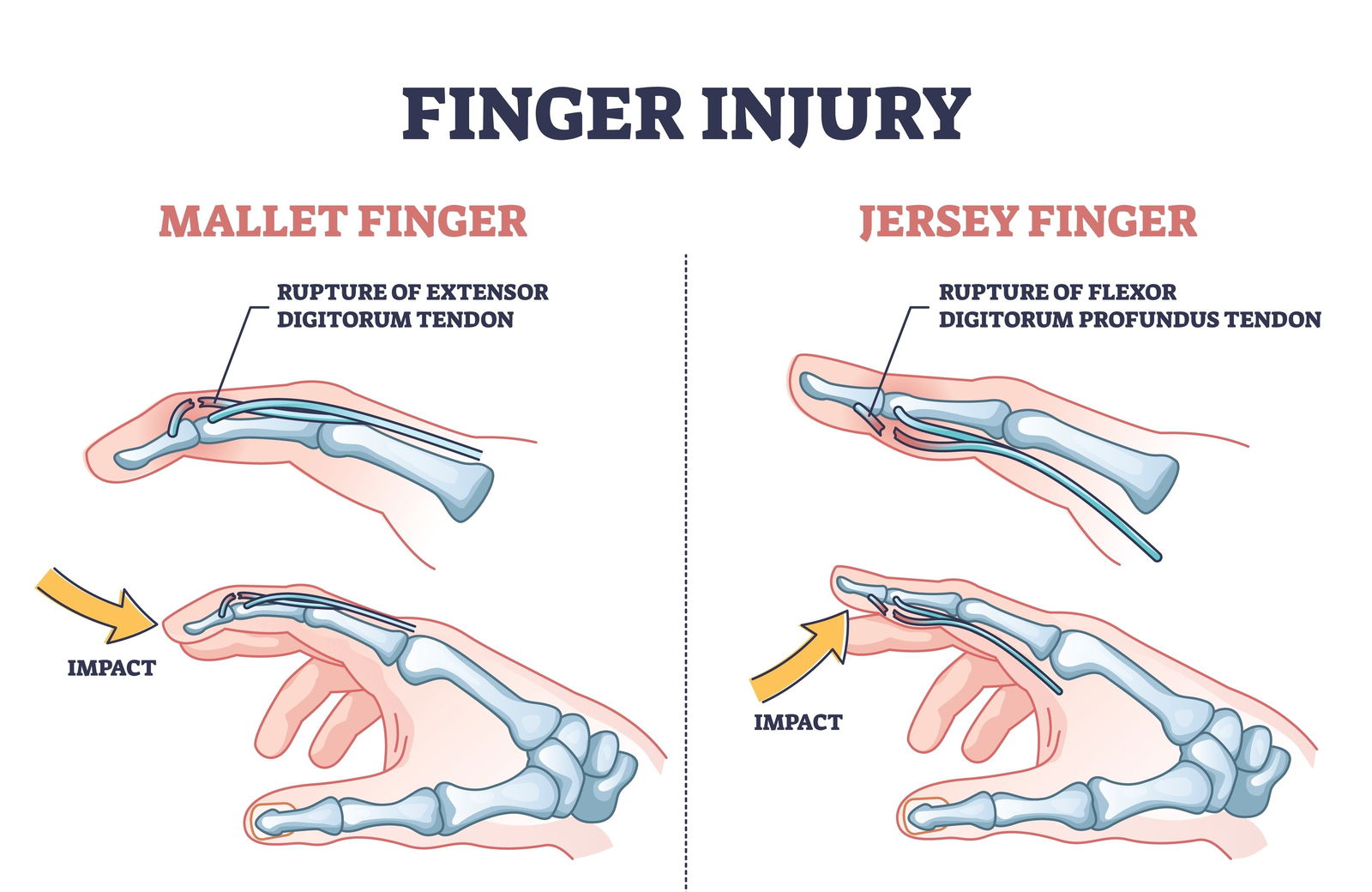 Jersey finger in Mallet finger