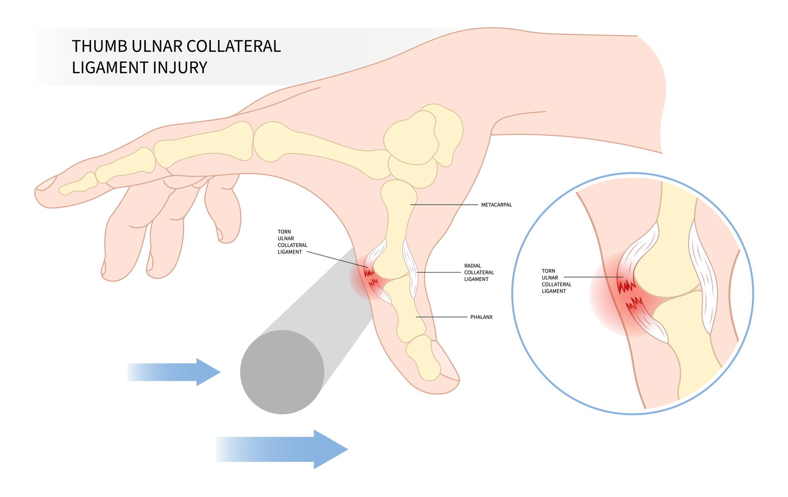 smularski palec poškodba ulnarnega kolateralnega ligamenta 