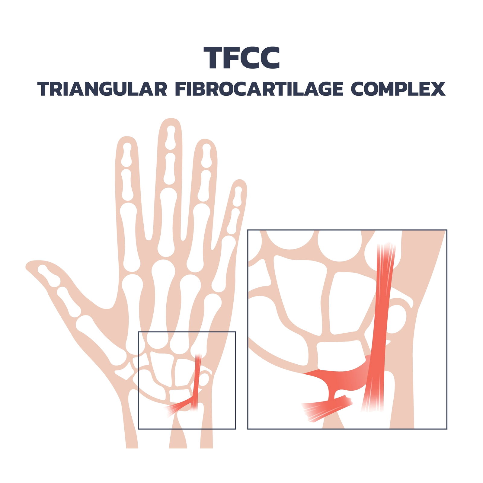 anatomija zapestja tfcc ligamentna struktura