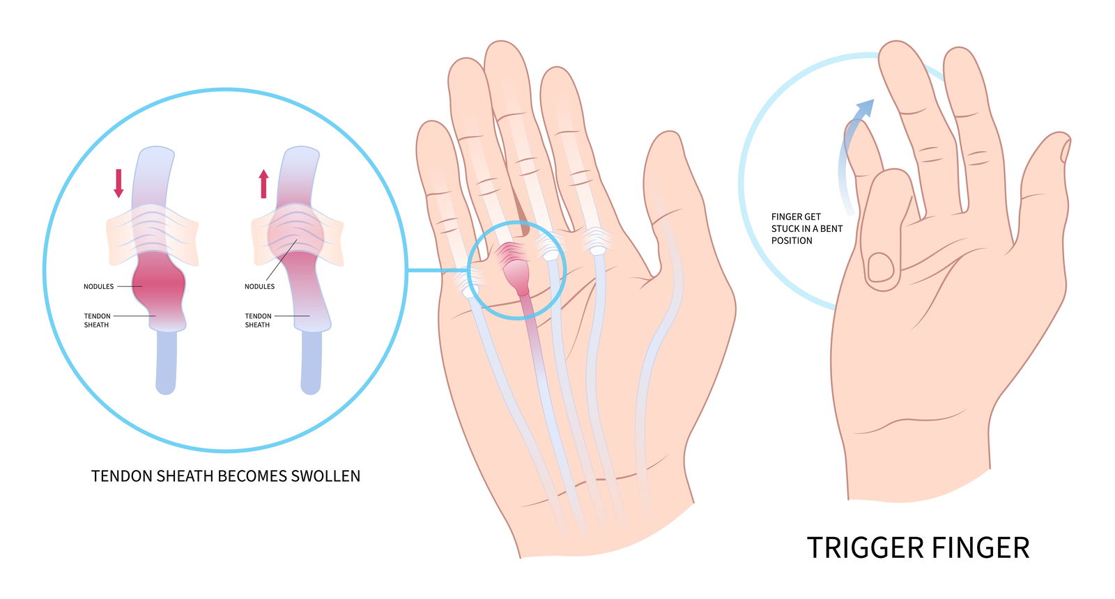 trigger finger prsti